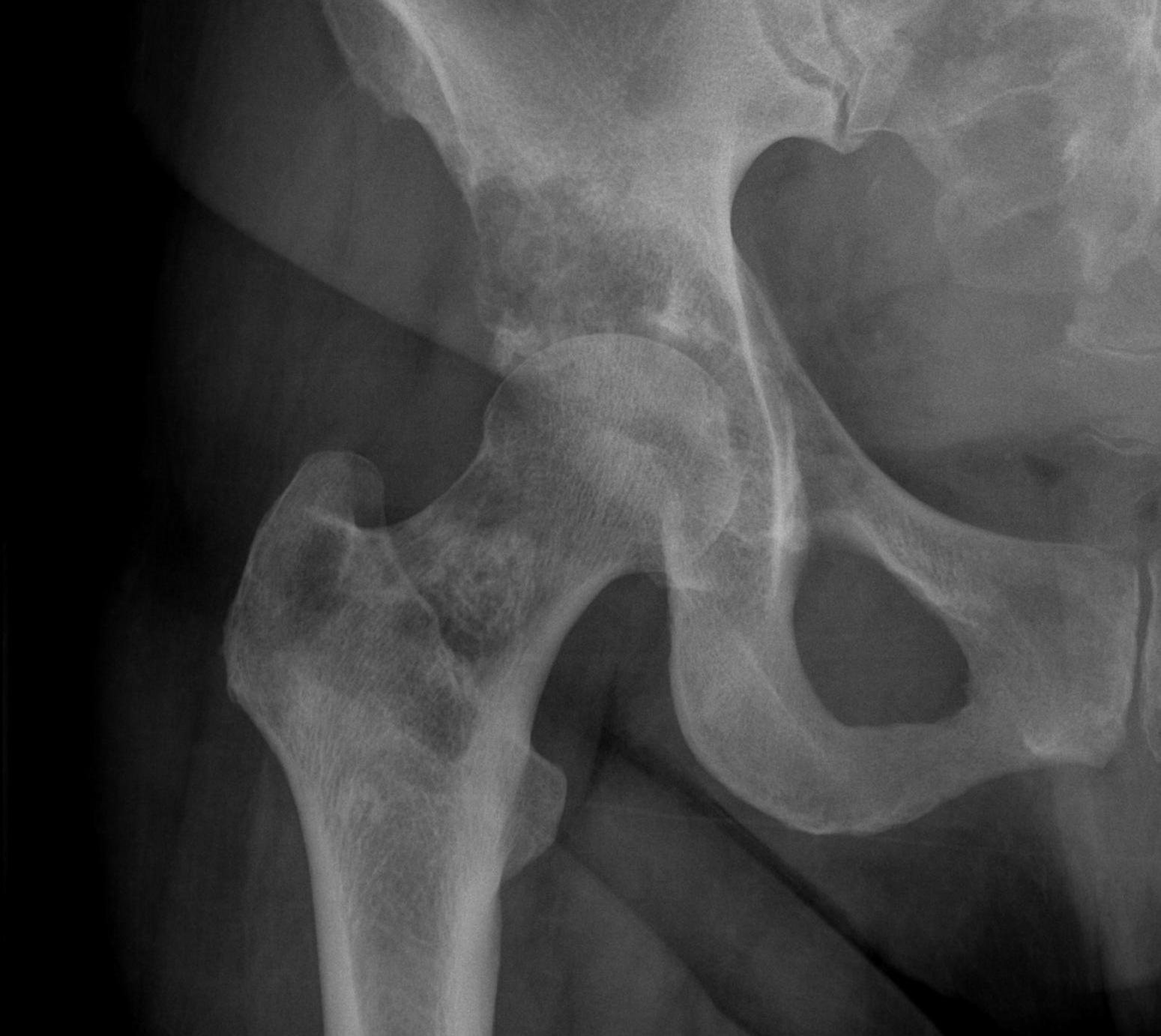 Metastasis Acetabulum Type III AP